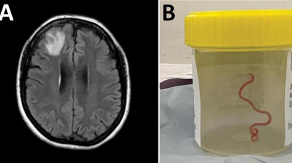 Bir hastanın beyninden canlı solucan çıkarıldı